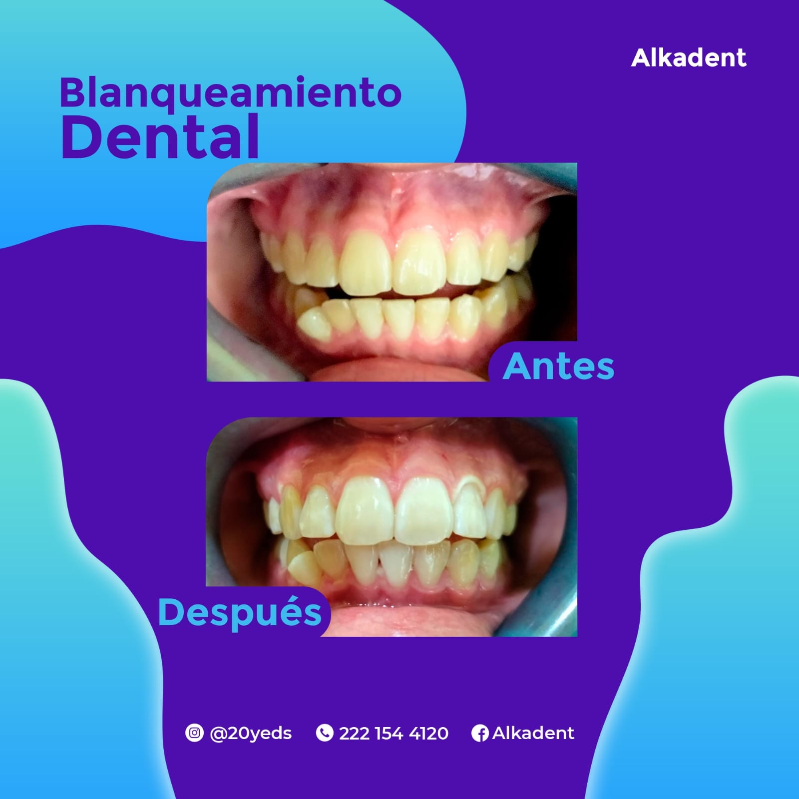 Blanqueamiento dental alkaden juchitan