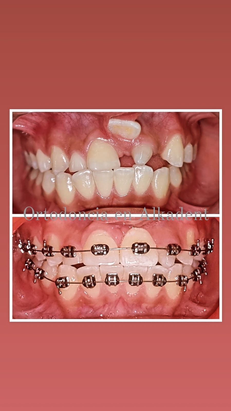 Blanqueamiento dental alkaden juchitan