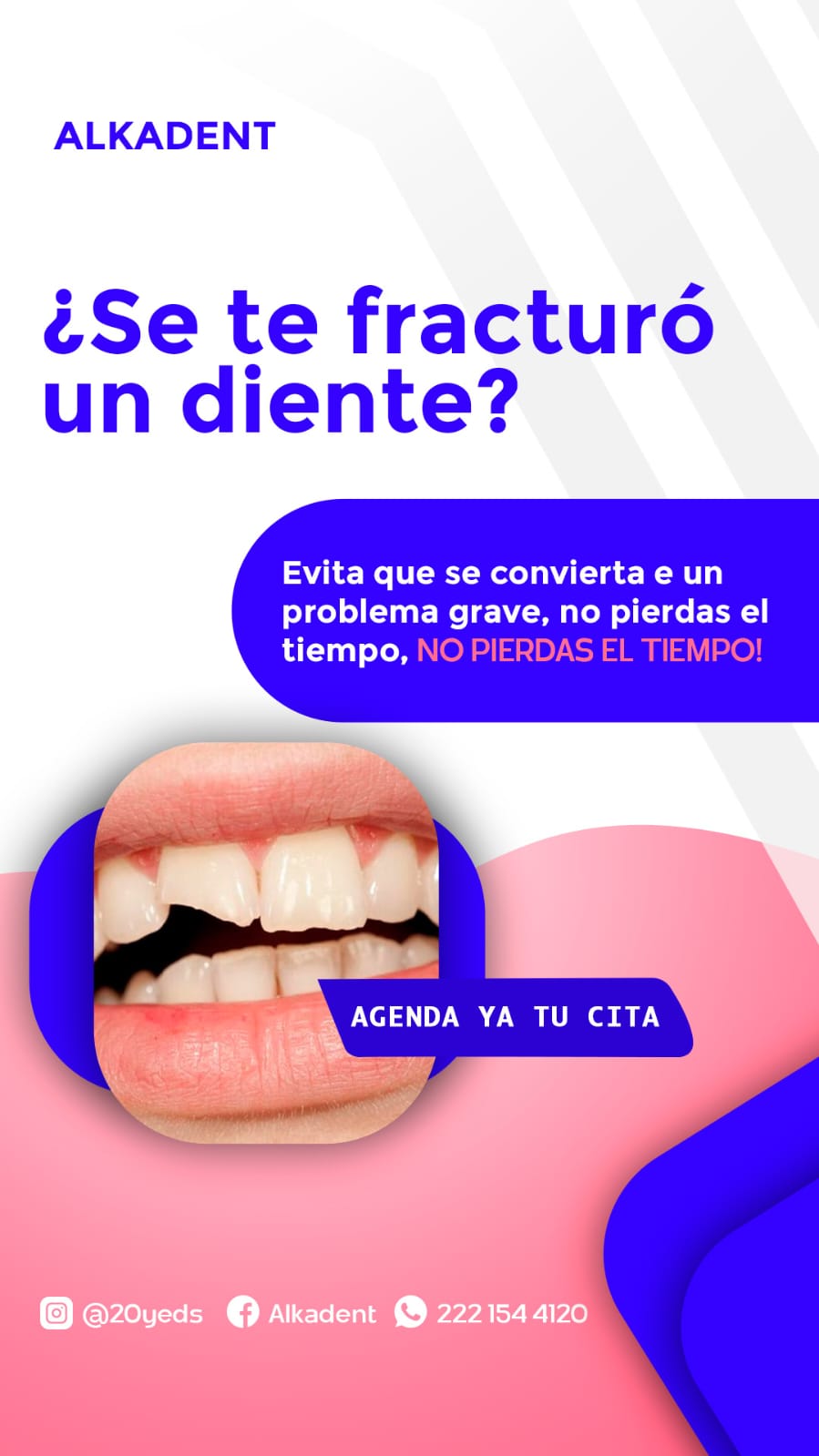 Fractura dental alkadent juchitan oaxaca tratamiento
