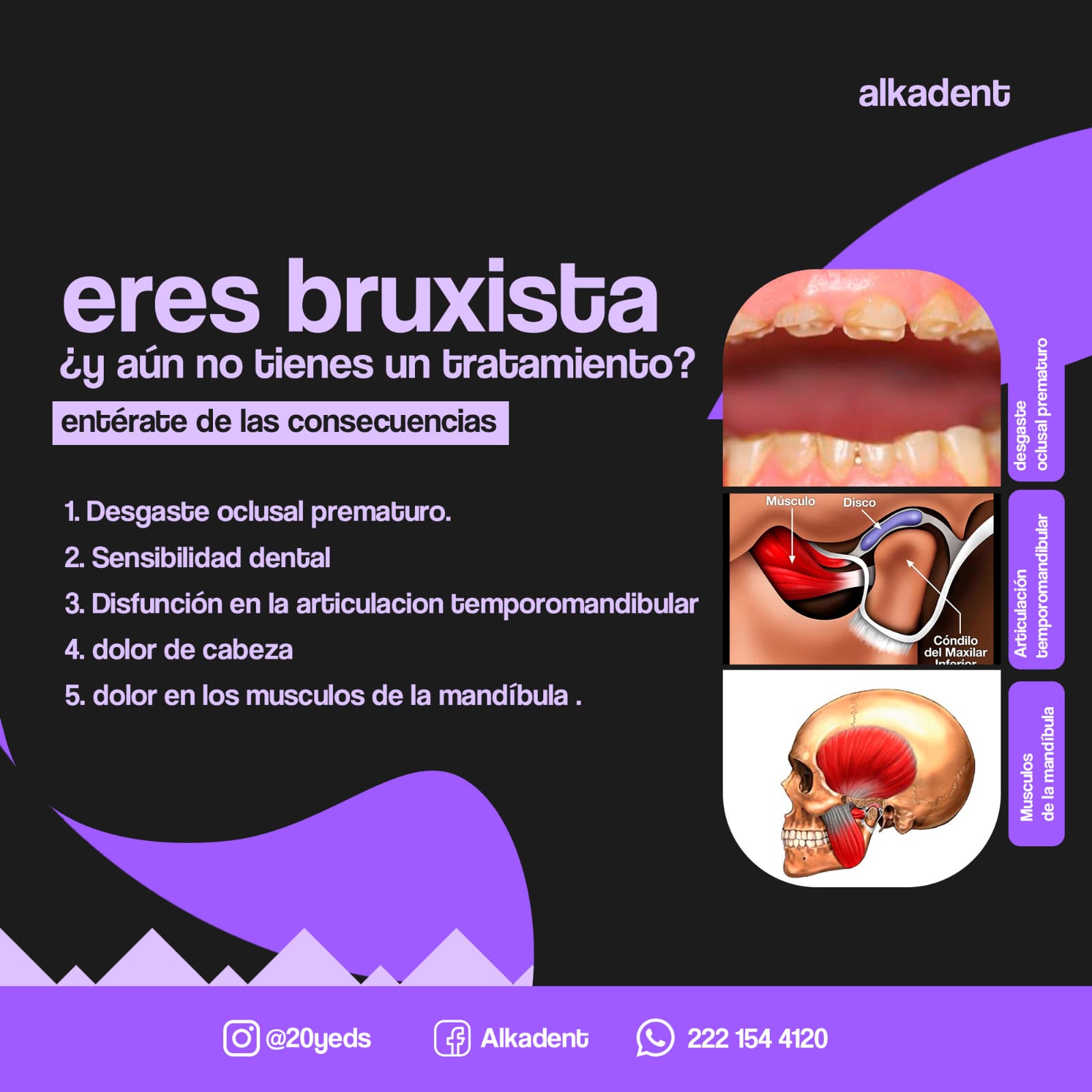 Bruxismo alkadent juchitan